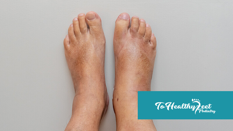 To healthy feet - blog - Diabetic Feet